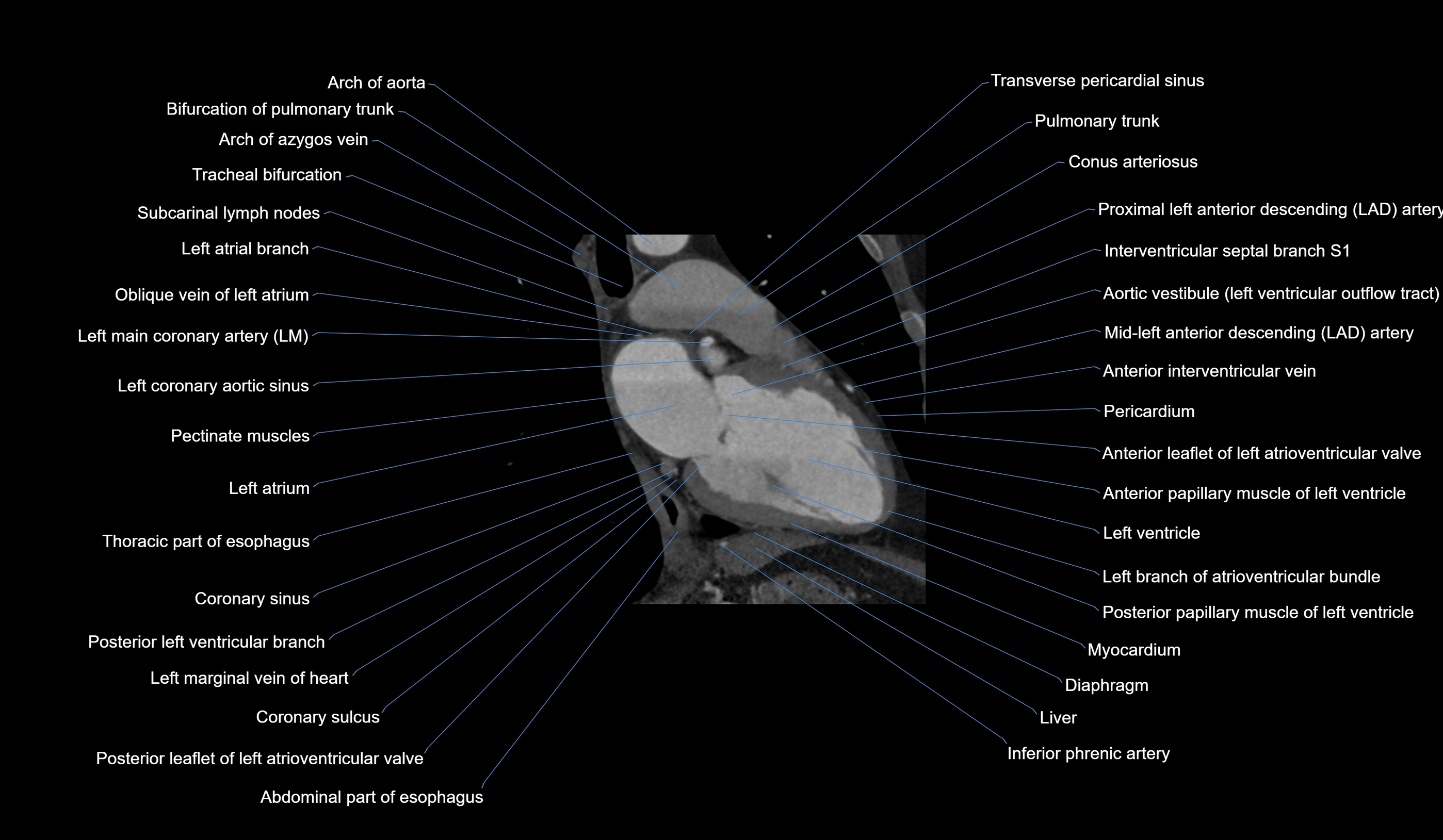 CT heart (coronary angiogram) 2 chamber view cross sectional anatomy labelled radiology image-00017.webp